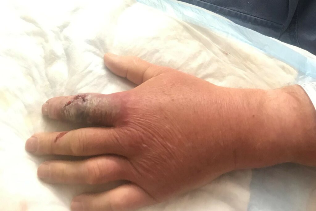 Image of someone's hand that has a Vibro, also known as the flesh-eating bacteria, infection.