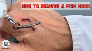 How to Remove a Fishing Hook - picture of a treble hook embedded in the back of an anglers hand